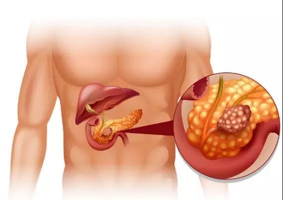 胰腺癌注意
