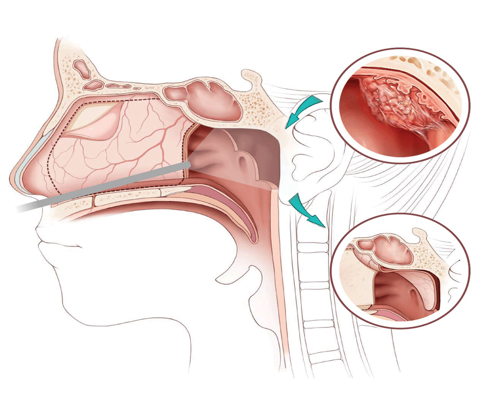 鼻咽癌疾病类型