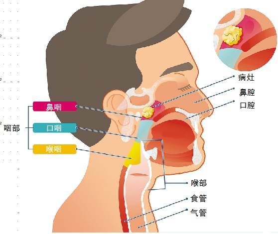 鼻咽癌症状.jpg