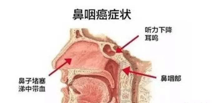 鼻咽癌检查.png