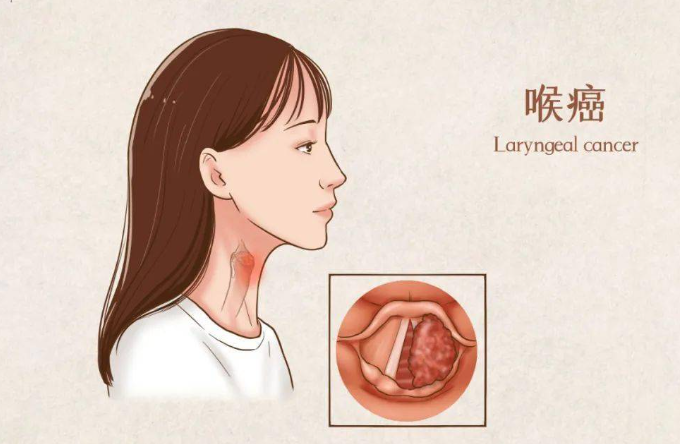 喉癌.png